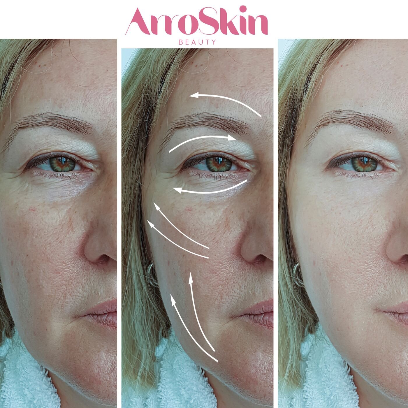 ArroSkin Lift